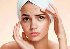 Địa chỉ trị mụn hiệu quả nhất quận Cầu Giấy, Hà Nội