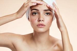 Địa chỉ nặn mụn uy tín nhất Hà Nội