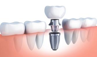 Địa chỉ trồng răng implant tốt nhất tỉnh Quảng Trị