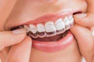 Địa chỉ niềng răng Invisalign uy tín, chất lượng nhất tại TP. HCM