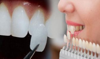 Địa chỉ bọc răng sứ uy tín nhất tỉnh Thái Nguyên