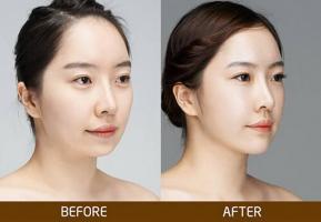 Địa chỉ độn cằm uy tín tại Hà Nội