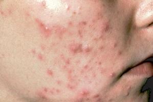 Bệnh ngoài da thường gặp vào mùa hè và cách phòng tránh
