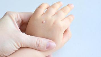 Bài thuốc dân gian tốt nhất xoá mụn cóc hiệu quả