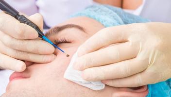 Địa chỉ tẩy nốt ruồi uy tín tại Hải Phòng