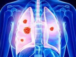 Sản phẩm hỗ trợ điều trị ung thư phổi tốt nhất hiện nay