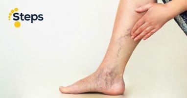 Bài tập giúp giảm tình trạng suy giãn tĩnh mạch chân hiệu quả nhất