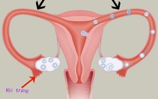 Biểu hiện điển hình của bệnh tắc vòi trứng chị em nên biết