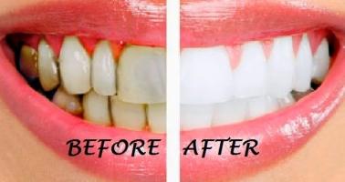Cách làm đẹp răng tự nhiên, trắng sáng hiệu quả nhất