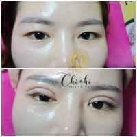 Địa chỉ nhấn mí đẹp và an toàn nhất Rạch Giá, Kiên Giang