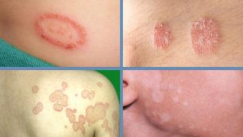 Công dụng, lưu ý khi dùng Canesten