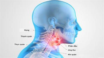 Dấu hiệu của ung thư vòm họng giai đoạn đầu