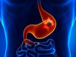 Dấu hiệu ung thư dạ dày bạn nên biết