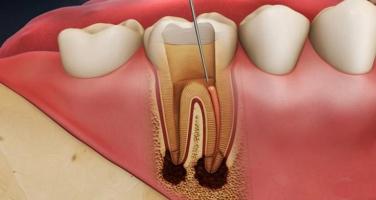 Địa chỉ điều trị viêm tủy răng hiệu quả hàng đầu tại TP. HCM