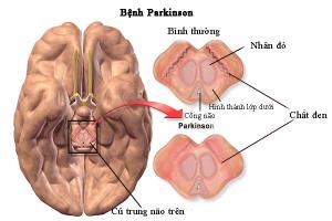 Địa chỉ khám và điều trị bệnh Parkinson tốt nhất TP. Hồ Chí Minh