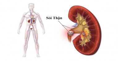 Địa chỉ khám và điều trị sỏi thận uy tín nhất Hà Nội