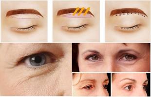 Địa chỉ nâng cung chân mày đẹp, uy tín nhất tỉnh Ninh Thuận