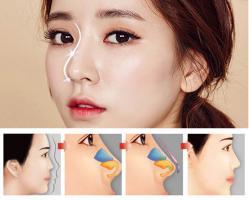 Địa chỉ nâng mũi đẹp và an toàn nhất tỉnh Ninh Thuận