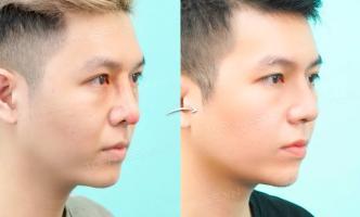 Địa chỉ nâng mũi nam đẹp và an toàn nhất ở TP. HCM