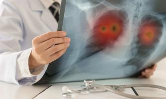 Địa chỉ tầm soát ung thư phổi tốt nhất tại Hà Nội