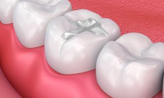 Địa chỉ trám răng uy tín và chất lượng nhất tại Quy Nhơn, Bình Định