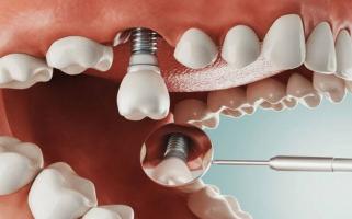 Địa chỉ cấy ghép implant tốt nhất Thái Bình