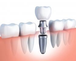 Địa chỉ trồng răng implant tốt nhất tỉnh Nghệ An