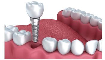 Địa chỉ trồng răng implant tốt nhất tỉnh Quảng Bình
