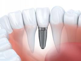 Địa chỉ trồng răng implant tốt nhất tỉnh Thanh Hóa