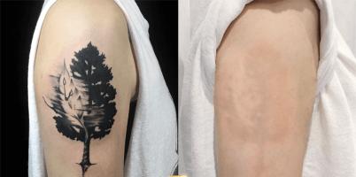 Địa chỉ xoá xăm uy tín nhất Đà Nẵng