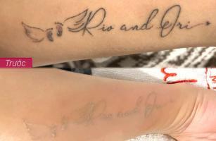 Địa chỉ xóa xăm uy tín nhất Tiền Giang