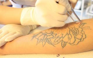 Địa chỉ xóa xăm tại Hà Nội: uy tín và an toàn nhất