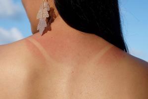 Điều bạn không nên làm khi bị cháy nắng