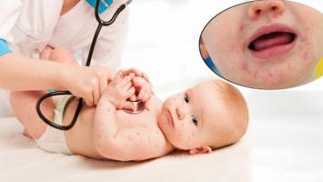 Điều bố mẹ nên biết về bệnh tay chân miệng ở trẻ nhỏ