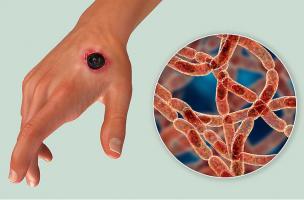 Điều cần biết về bệnh than