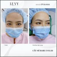 Địa chỉ cắt mí đẹp và an toàn nhất quận 10, TP. HCM