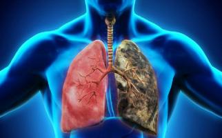 Lưu ý quan trọng nhất về bệnh lao phổi