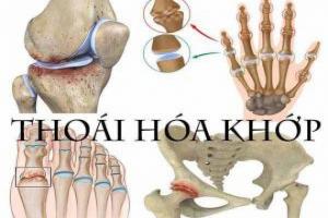 Lưu ý quan trọng nhất về thoái hóa khớp