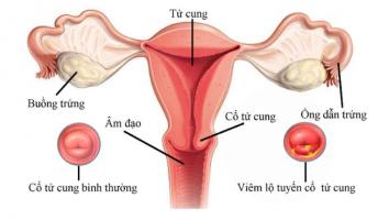 Nguyên nhân, triệu chứng và cách điều trị viêm lộ tuyến cổ tử cung