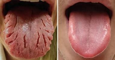 Màu lưỡi bất thường báo hiệu cơ thể bạn mắc bệnh lý từ lâu