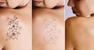 Máy xóa xăm tốt nhất dành cho spa