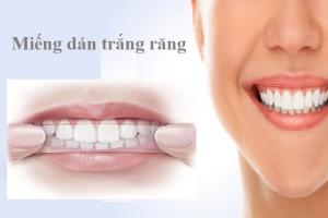 Miếng dán trắng răng tốt nhất hiện nay