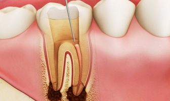 Nha khoa điều trị tủy răng uy tín nhất Hà Nội