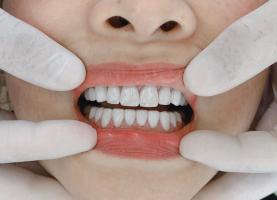 Địa chỉ tẩy trắng răng uy tín nhất tỉnh Hưng Yên