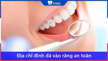 Địa chỉ đính đá răng đẹp và an toàn nhất tại TP. HCM