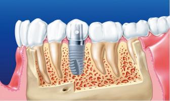 Nha khoa trồng răng implant tốt uy tín tại TP. Biên Hòa, Đồng Nai