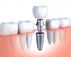 Nha khoa trồng răng implant tốt nhất tại Quận 5, TP HCM