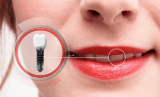 Quy trình trồng răng Implant chuẩn Quốc Tế