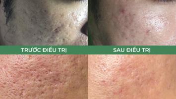 Spa trị sẹo rỗ do mụn tốt nhất TP. Buôn Ma Thuột, Đắk Lắk