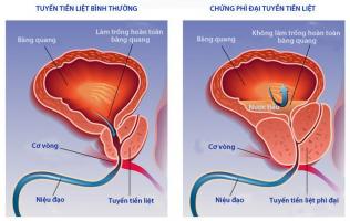 Thực phẩm chức năng hỗ trợ điều trị phì đại tiền liệt tuyến tốt nhất